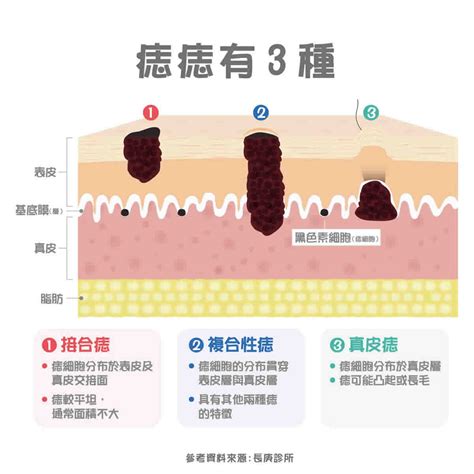 臉部有痣|痣變大、痣多或長毛會變皮膚癌？認識痣的形成與原因